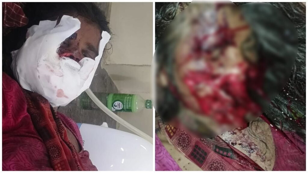 Terror of Bears : मनेन्द्रगढ़ ब्रेकिंग…! 9 महीने की गर्भवती पर भालुओं ने किया हमला…गंभीर हालत में अंबिकापुर रेफर…कमजोर दिल वाले न देखें VIDEO