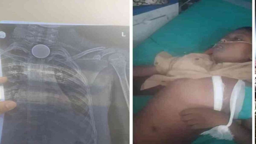 Coin Stuck: Heartbreaking incident from Korba! 8-year-old boy swallows coin... painful death... family distraught