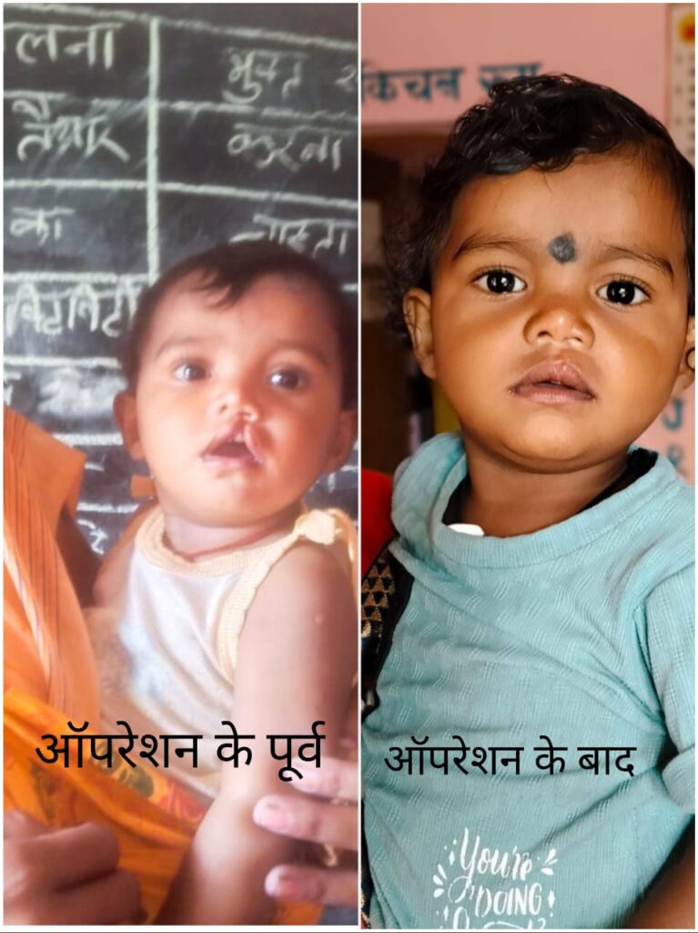 Chirayu Yojana : जन्मजात बीमारी से संघर्ष कर रही बच्ची को चिरायु योजना से मिला नया जीव