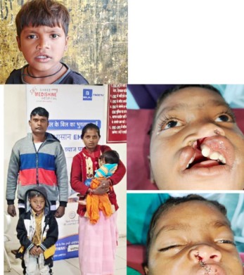 Bastar : जन्मजात कटे होंठ-तालु से जूझ रहे विक्रम को मिली नई मुस्कान…चिरायु योजना से हुआ सफल ऑपरेशन