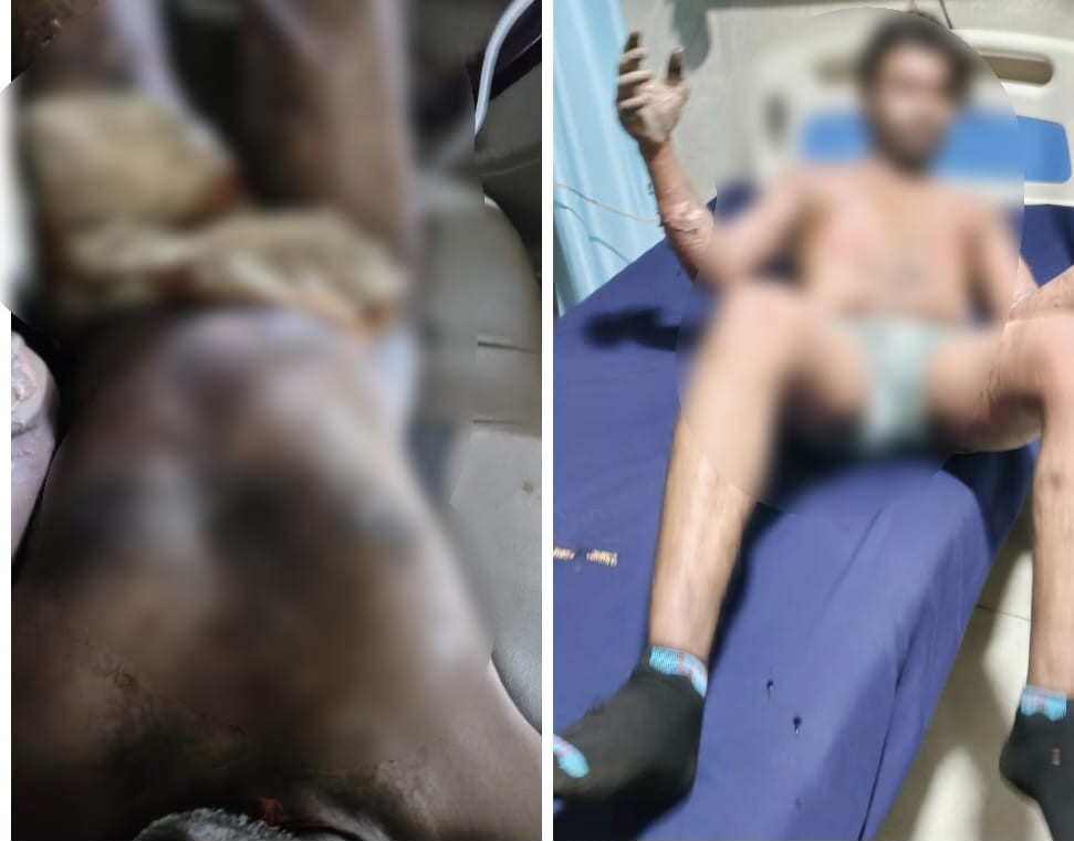 Accident in Iron Plant : बिलासपुर के नोवा स्पंज आयरन प्लांट में बड़ा हादसा…! खौलता लोहा गिरने से 4 मजदूर गंभीर रूप से झुलसे…यहां देखें Video